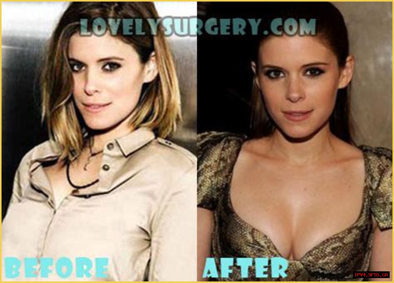 Kate Mara Plastic Surgery Before and After